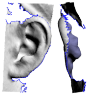 Fig 4. Missing Behind Ear